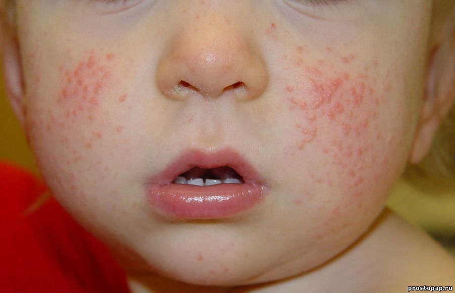 аллергический дерматит у детей фото